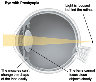 Cross section of eye showing light focused behind retina.
