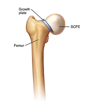 Front view of femur showing femoral head slipping off growth plate (SCFE).