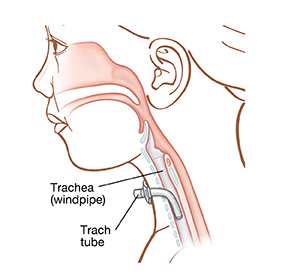 Outline of child's head showing esophagus, trachea, and trach tube inserted in neck into trachea.