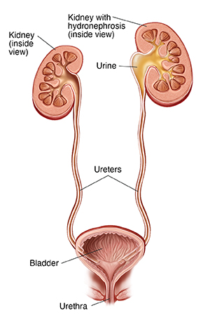 Front view cross section of kidneys, ureters, and bladder. Left ureter is blocked near kidney, with urine backing up into kidney.