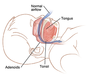 Side view cross section of child's head showing tongue, adenoids, and tonsil. Arrow shows normal airflow going through nose, past adenoids and tonsils.