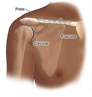 Anterior view of shoulder joint showing bones with internal fixation device screwed into fractured clavicle.