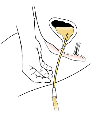 Corte transversal de un catéter en una uretra, que drena la orina de la vejiga.