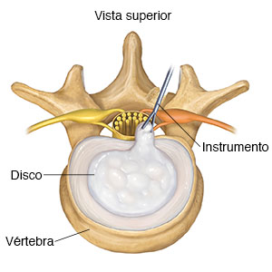 Vista superior de una vértebra lumbar que muestra la extracción posterior de un disco herniado.