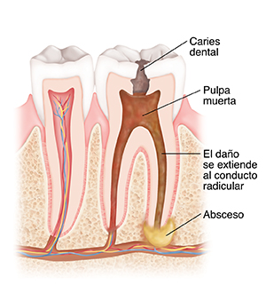 Corte transversal de un diente con caries, pulpa necrótica y absceso.