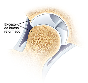 Corte transversal de una articulación de cadera en donde se ve hueso sobrante reformado de la cabeza del fémur y el reborde de la cavidad.