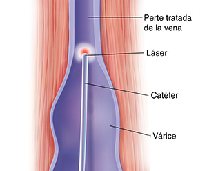 Corte transversal de músculo y vena donde puede verse un catéter láser en la vena.