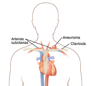 Diagrama de la cabeza y el pecho en el que se muestran el corazón, las arterias, la clavícula, el esternón y el aneurisma de la subclavia.
