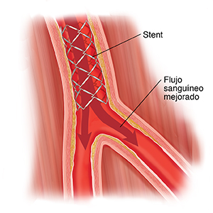 Corte transversal de una arteria con músculo alrededor que tiene colocado un stent para mantener la arteria abierta.