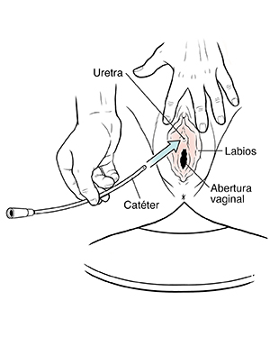 Primer plano de una vulva que muestra las manos colocando la sonda en la uretra.