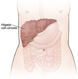 Vista frontal de un contorno femenino donde pueden verse el sistema digestivo y el hígado con cirrosis.