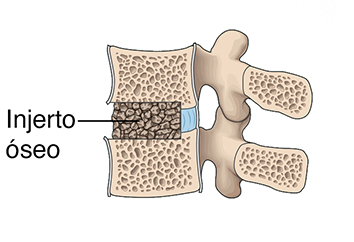 Corte transversal de las vértebras lumbares donde se observa un injerto óseo entre las vértebras.