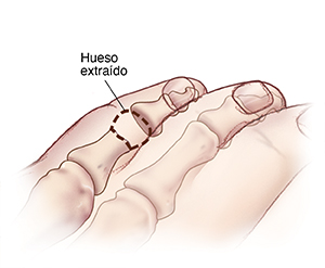 Vista superior del quinto dedo del pie encogido con una línea de puntos donde se observa el hueso extraído por artroplastia con derrotación.
