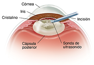 Corte transversal del frente de un ojo en donde se ve un instrumento que realiza una facoemulsificación.