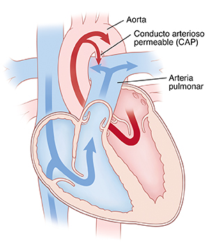 Corte transversal de un corazón en el que se ve un conducto arterioso permeable.