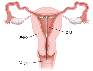 Corte transversal de un útero y una vagina en donde se ve un dispositivo intrauterino (DIU) colocado en el útero.
