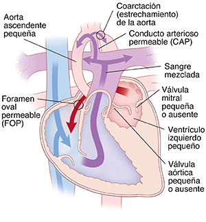 Corte transversal de vista frontal de un corazón que muestra síndrome de corazón hipoplásico izquierdo: coartación (estrechamiento) de la aorta, conducto arterioso permeable, válvula mitral pequeña o ausente, ventrículo izquierdo pequeño, válvula aórtica pequeña o ausente, agujero oval permeable y una aorta ascendente pequeña. Las flechas muestran que la sangre circula de la aurícula izquierda a la derecha a través del agujero oval permeable y que la sangre mezclada va del ventrículo derecho a la arteria pulmonar e ingresa en la aorta por el conducto arterioso permeable.