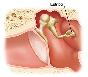 Corte transversal de un oído, donde pueden verse las estructuras del oído externo, interno y medio, con el estribo dañado.