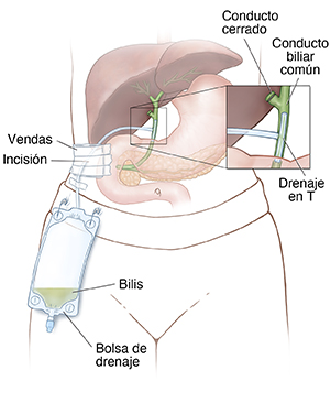 Vista frontal de un torso donde se observa el hígado, el estómago y el páncreas con un drenaje en T y una bolsa colocada para el drenaje. El recuadro muestra un primer plano del drenaje en T en el conducto biliar.