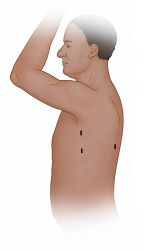 Vista lateral de un torso masculino en el que se muestran lugares donde pueden hacerse las incisiones para una toracoscopia.