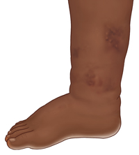 Vista lateral de una pierna que muestra hinchazón del tobillo y el pie.