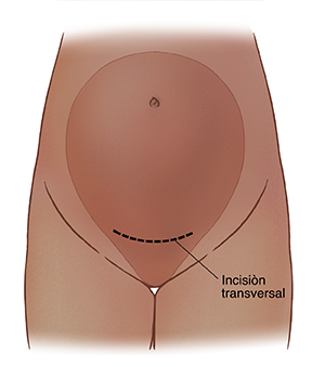 Imagen de una incisión transversal