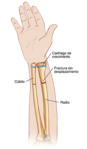 Vista de la palma de la mano y antebrazo donde pueden verse el radio y el cúbito. Se ven fracturas sin desplazamiento que atraviesan el radio y el cúbito. Los extremos de los huesos están alineados. Las placas de crecimiento se encuentran cerca de la muñeca.
