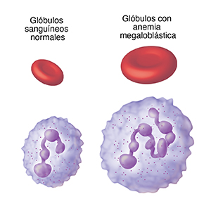 Glóbulo rojo en forma de disco y glóbulo blanco esférico, ambos normales. Junto a estos, hay glóbulos rojos mucho más grandes y glóbulos blancos con anemia megaloblástica.