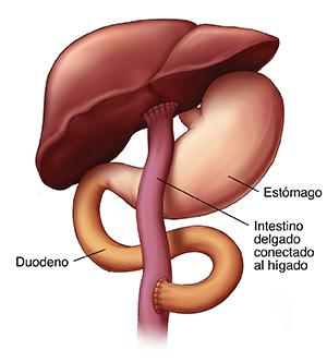 Vista frontal del hígado y el estómago donde puede verse el intestino delgado conectado al hígado después de un procedimiento de Kasai.